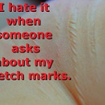 Stretch Marks
