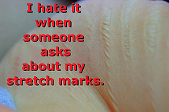 Stretch Marks