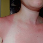 Sun Burned Skin from the Beach